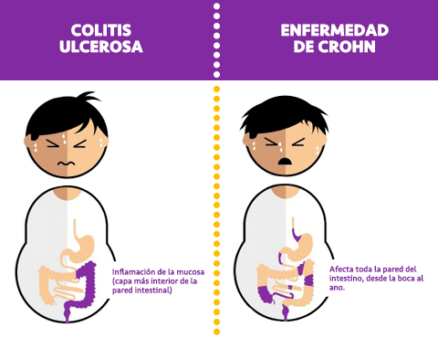 enfermedad-crohn-colitis-ulcerosa